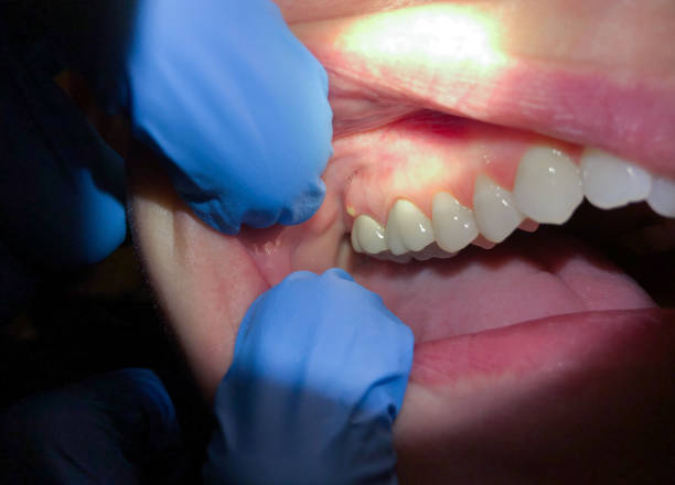 Best Emergency Dentist for Lost Fillings or Crowns in St Simons, GA