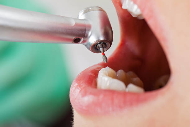 Best Emergency Dental Extractions in St Simons, GA